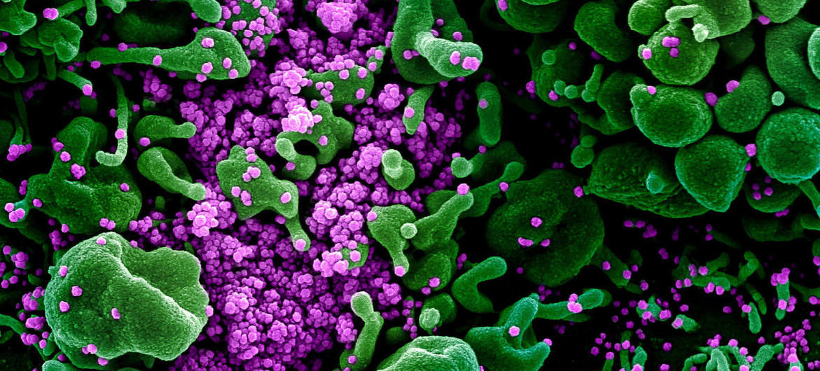 Una imagen digitalmente aumentada de una muestra de un paciente presenta células verdes muy infectadas con la partícula de virus SARS-COV-2 de color púrpura.