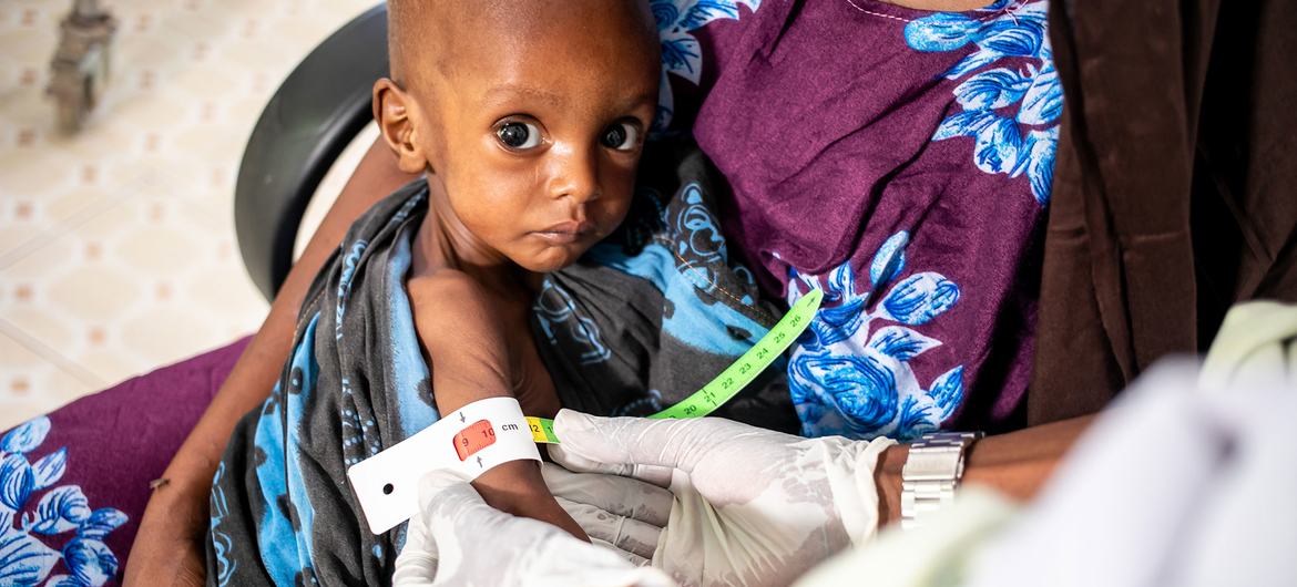 Este pequeño de un año con desnutrición grave recibe atención en un hospital de Dolow, Etiopía.