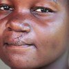 Abandonada por su padre al nacer, Agnes, del sudoeste de Tanzania, vivió por 15 años fuera de su comunidad debido a su aspecto.